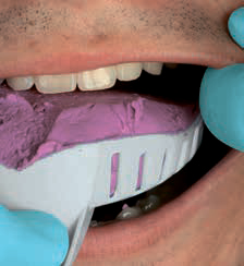 Zhermack Гидрогум 5 - во рту